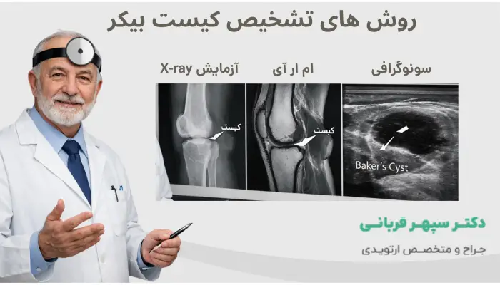 روش های تشخیص کیست بیکر