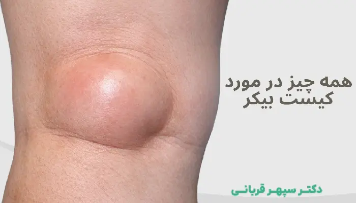 همه چیز در مورد کیست بیکر علت، علائم، تشخیص و درمان