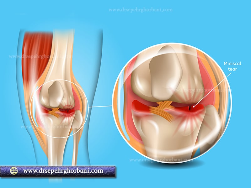 آیا می دانید پارگی منیسک زانو چگونه درمان می شود؟