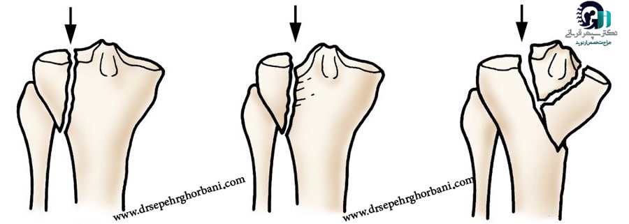 علائم پس از جراحی شکستگی استخوان تیبیا