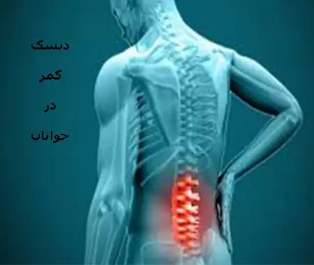 دیسک کمر در جوانان