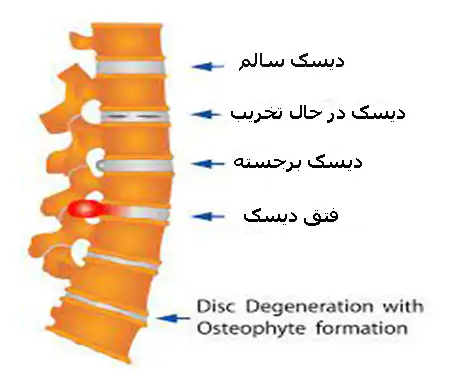 مهره های دیسک