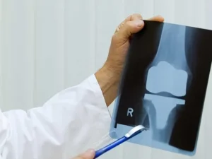 بهترین جراح تعویض مفصل زانو در زنجان