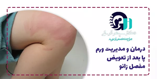 درمان و مدیریت ورم پا بعد از تعویض مفصل زانو
